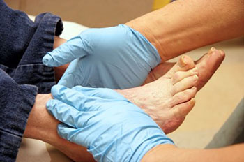 Diabetic foot treatment in the Chatham County, GA: Pooler (Bloomingdale, Meldrim, Eden, Garden City, Port Wentworth, Savannah, Rincon, Georgetown) and Beaufort County, SC: Bluffton, Hilton Head Island, Okatie, Pritchardville, Palmetto Bluff, Levy, Limehouse, Hardeeville, Brighton Beach, Harbour Town, Windmill Harbor areas