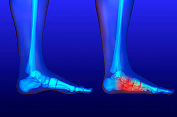 Flat feet and Fallen Arches treatment in the Chatham County, GA: Pooler (Bloomingdale, Meldrim, Eden, Garden City, Port Wentworth, Savannah, Rincon, Georgetown) and Beaufort County, SC: Bluffton, Hilton Head Island, Okatie, Pritchardville, Palmetto Bluff, Levy, Limehouse, Hardeeville, Brighton Beach, Harbour Town, Windmill Harbor areas