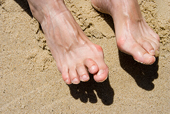 Hammertoes treatment in the Chatham County, GA: Pooler (Bloomingdale, Meldrim, Eden, Garden City, Port Wentworth, Savannah, Rincon, Georgetown) and Beaufort County, SC: Bluffton, Hilton Head Island, Okatie, Pritchardville, Palmetto Bluff, Levy, Limehouse, Hardeeville, Brighton Beach, Harbour Town, Windmill Harbor areas