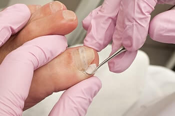 Ingrown toenails treatment in the Chatham County, GA: Pooler (Bloomingdale, Meldrim, Eden, Garden City, Port Wentworth, Savannah, Rincon, Georgetown) and Beaufort County, SC: Bluffton, Hilton Head Island, Okatie, Pritchardville, Palmetto Bluff, Levy, Limehouse, Hardeeville, Brighton Beach, Harbour Town, Windmill Harbor areas