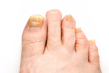 Fungal toenail treatment in the Chatham County, GA: Pooler (Bloomingdale, Meldrim, Eden, Garden City, Port Wentworth, Savannah, Rincon, Georgetown) and Beaufort County, SC: Bluffton, Hilton Head Island, Okatie, Pritchardville, Palmetto Bluff, Levy, Limehouse, Hardeeville, Brighton Beach, Harbour Town, Windmill Harbor areas