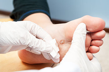 Plantar warts specialist in the Chatham County, GA: Pooler (Bloomingdale, Meldrim, Eden, Garden City, Port Wentworth, Savannah, Rincon, Georgetown) and Beaufort County, SC: Bluffton, Hilton Head Island, Okatie, Pritchardville, Palmetto Bluff, Levy, Limehouse, Hardeeville, Brighton Beach, Harbour Town, Windmill Harbor areas