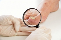 Tips to Prevent Fungal Toenail Infections