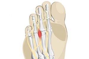Morton’s Neuroma and Wearing High Heels