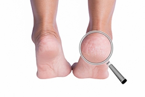 Drinking Water May Help Cracked Heels