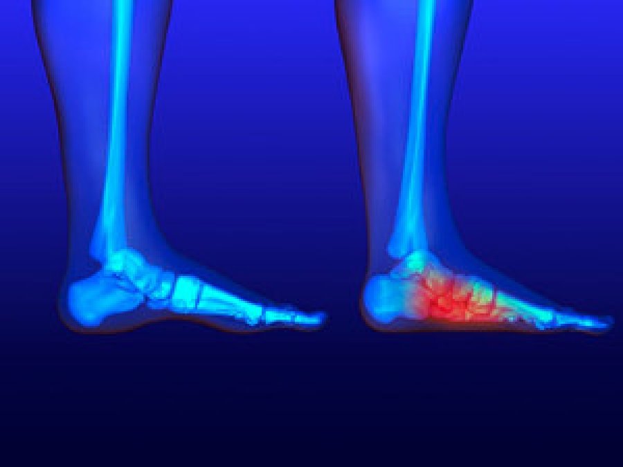 I have no arch in my foot sale