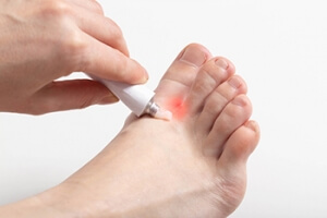 Causes of Athlete&#039;s Foot and Ways to Avoid It