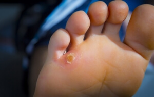 Seed Corns on the Feet