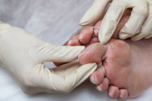Understanding the Impact of Diabetes on the Feet